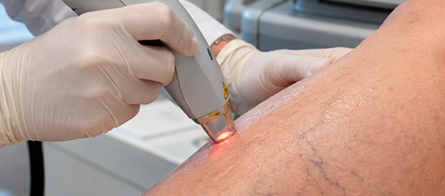 Tratamento a laser